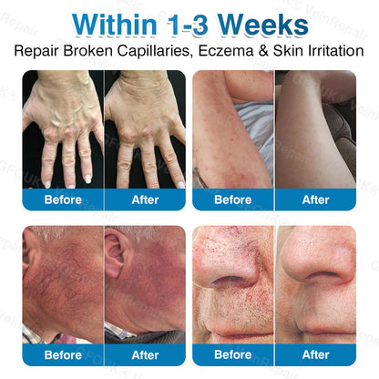 🇺🇸🏆✅️🏃Pryxo™ VeinRepair Microneedle Patch Roll⚡Instant Relief, Long-Term Results